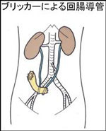 ブリッカーによる回腸導管