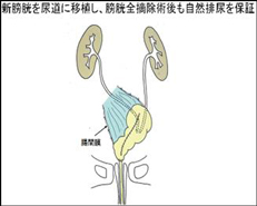 尿道から自然排尿が可能な術式